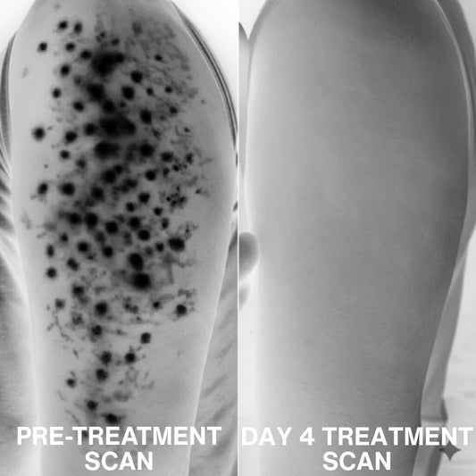 Advanced Triple-Acid Complex for Keratosis Pilaris
