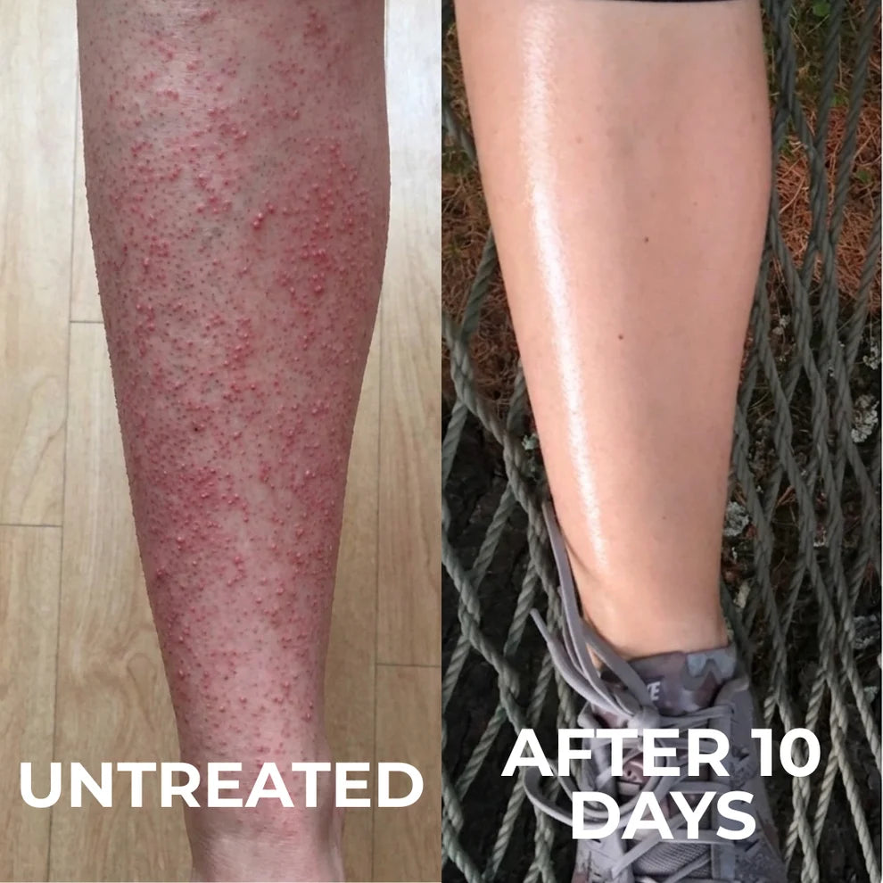 Advanced Triple-Acid Complex for Keratosis Pilaris