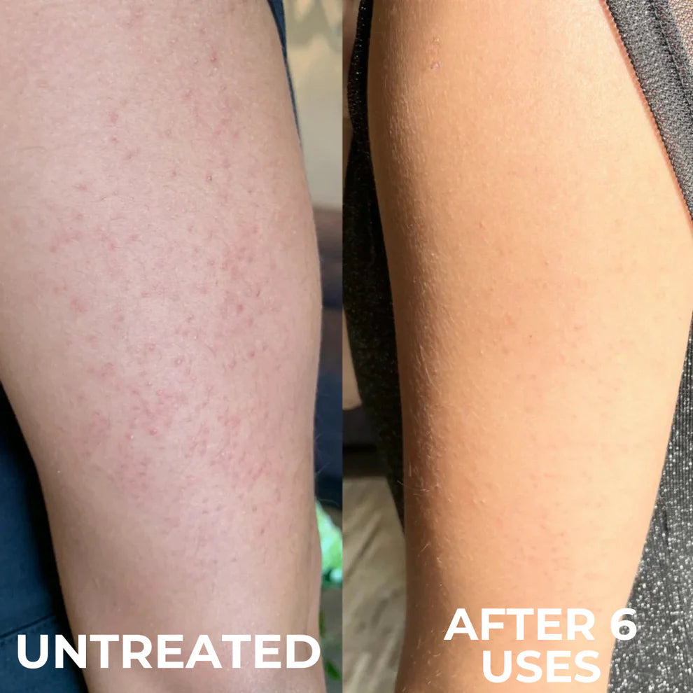 Advanced Triple-Acid Complex for Keratosis Pilaris